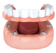 All-on-4 Dental Implants | Teeth in a Day | Tooth Implants Dedham MA