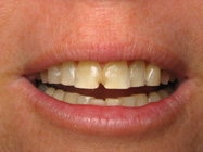 Before Porcelain Veneers