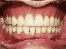 Complete Dentures Dedham MA