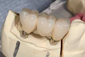 Implant Supported Bridges