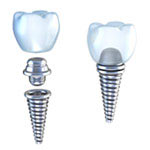 Dental Implants Illinois