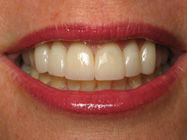 Porcelain Veneers for Teeth