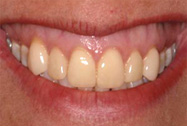 Professional Teeth Whitening