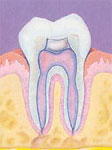 Root Canal (After)