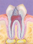 Root Canal (Before)