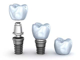 Single Tooth Implant
