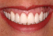 Zoom! Teeth Whitening Dedham MA
