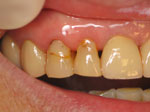 Cosmetic Bonding Dedham MA