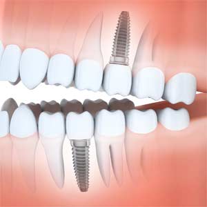 Dental Implants Crest Hill IL