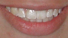 After Express Smiles