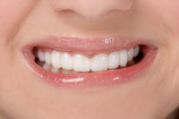 After Snap-On Smile