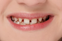 Before Snap-On Smile