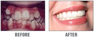 Before & After Cosmetic Dentistry